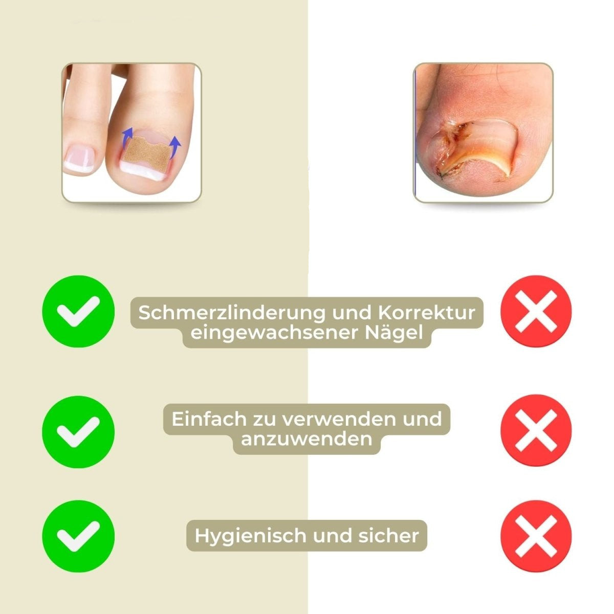 Easy Nail Correction Strips for Ingrown Toenails