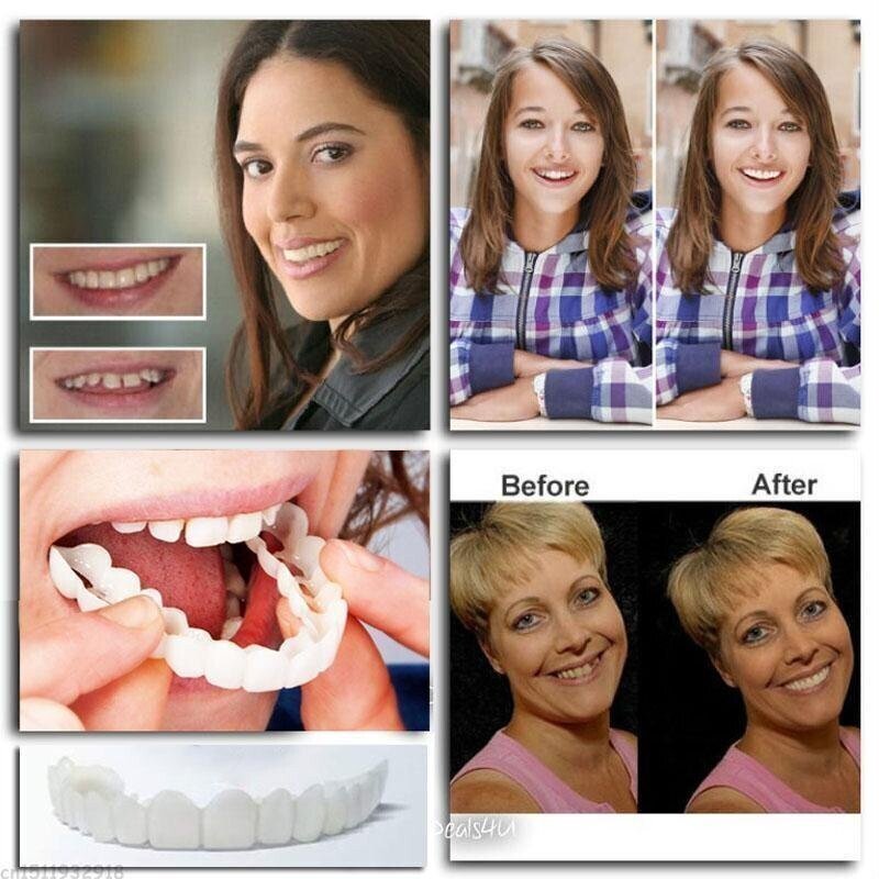 Easy Fit Snap-In Dentures