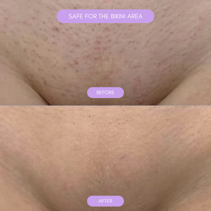 Easy at Home Hair Remover Noxord