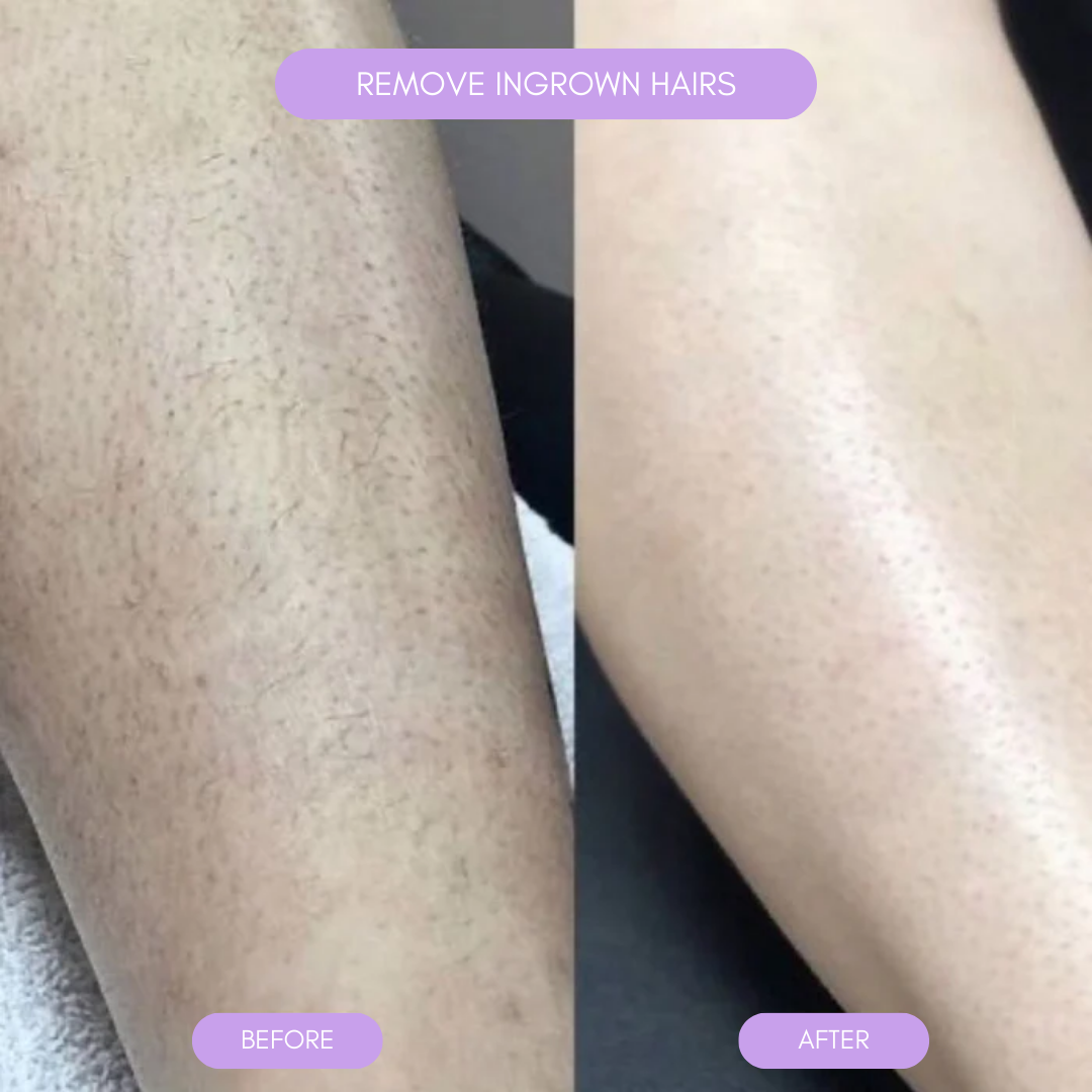Easy at Home Hair Remover Noxord