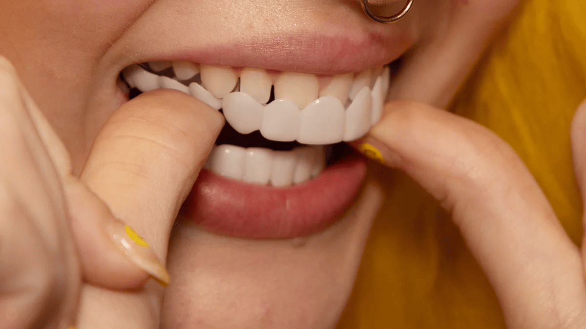 Easy Snap On Smile Dental Veneers