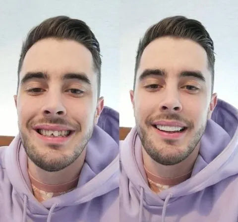 Easy Fit Dental Veneers Set