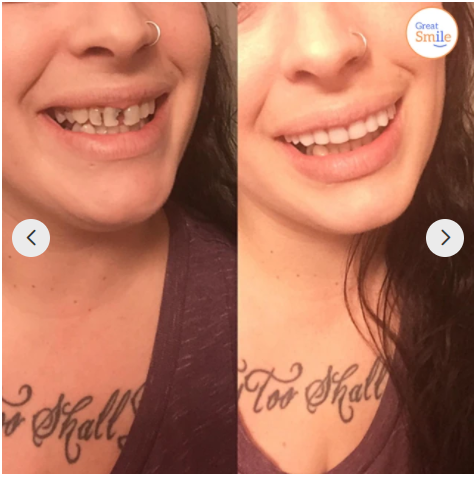 Easy Fit Dental Implant Snap On Denture