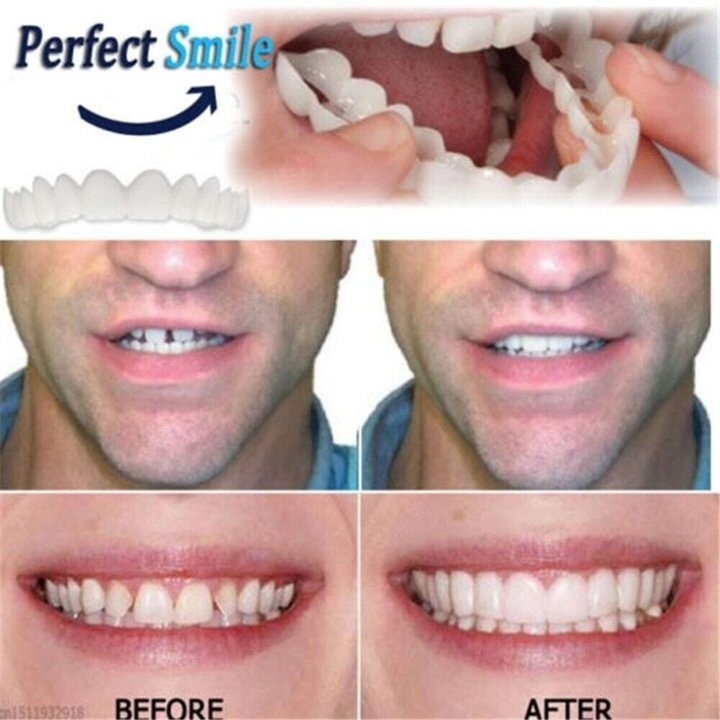 Easy Fit Snap-In Dentures