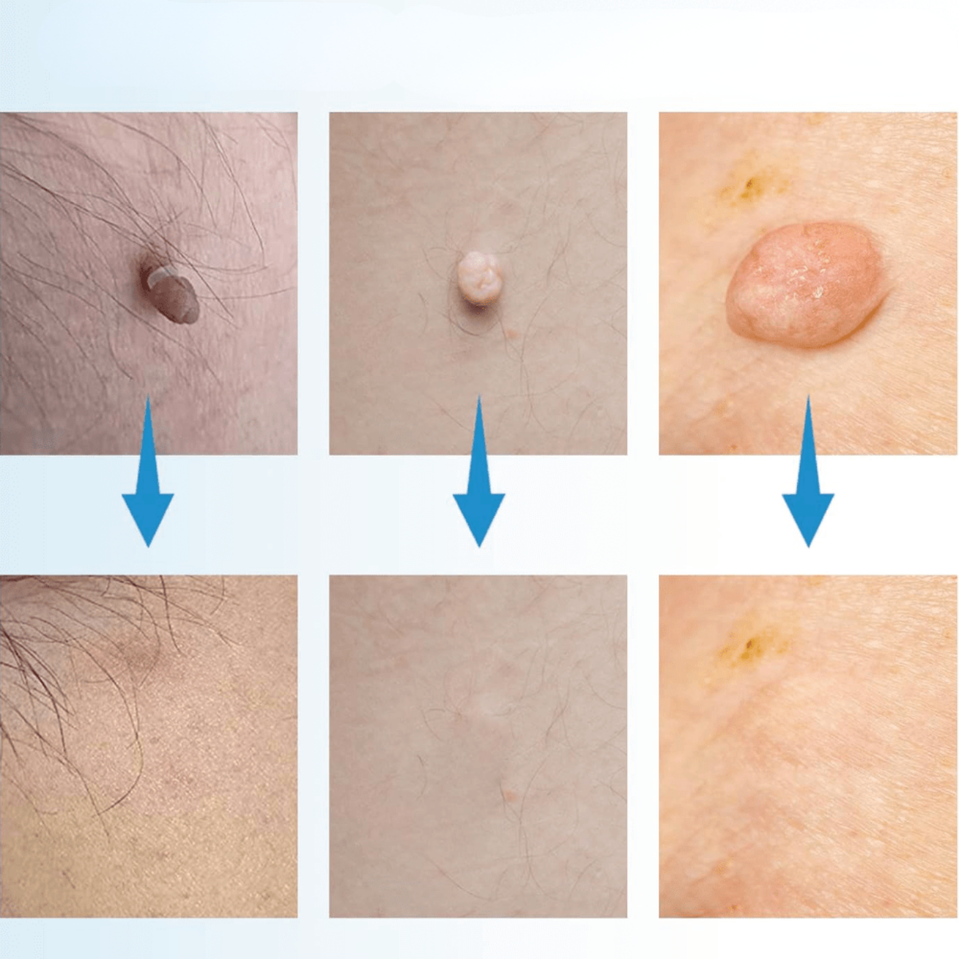 Fast Acting Wart Treatment Cream