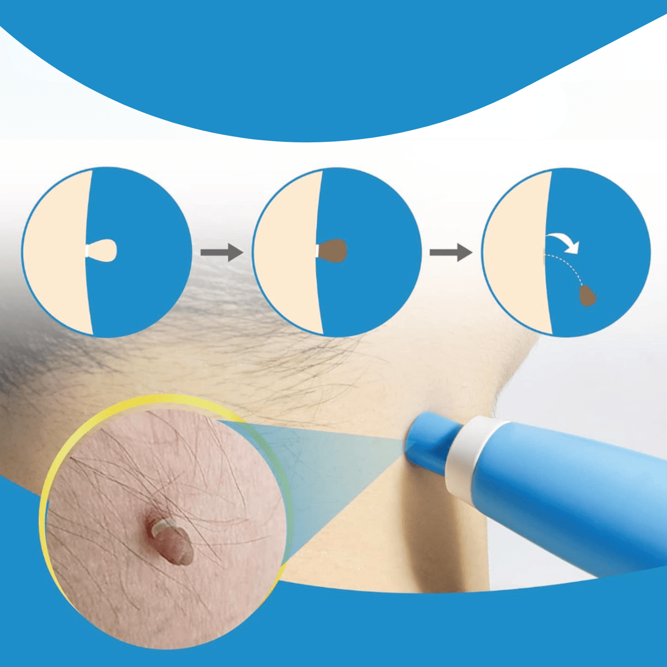 Fast Acting Wart Treatment Cream