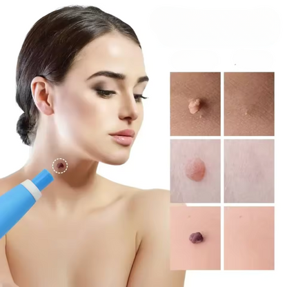Fast Acting Wart Treatment Cream - Cofik