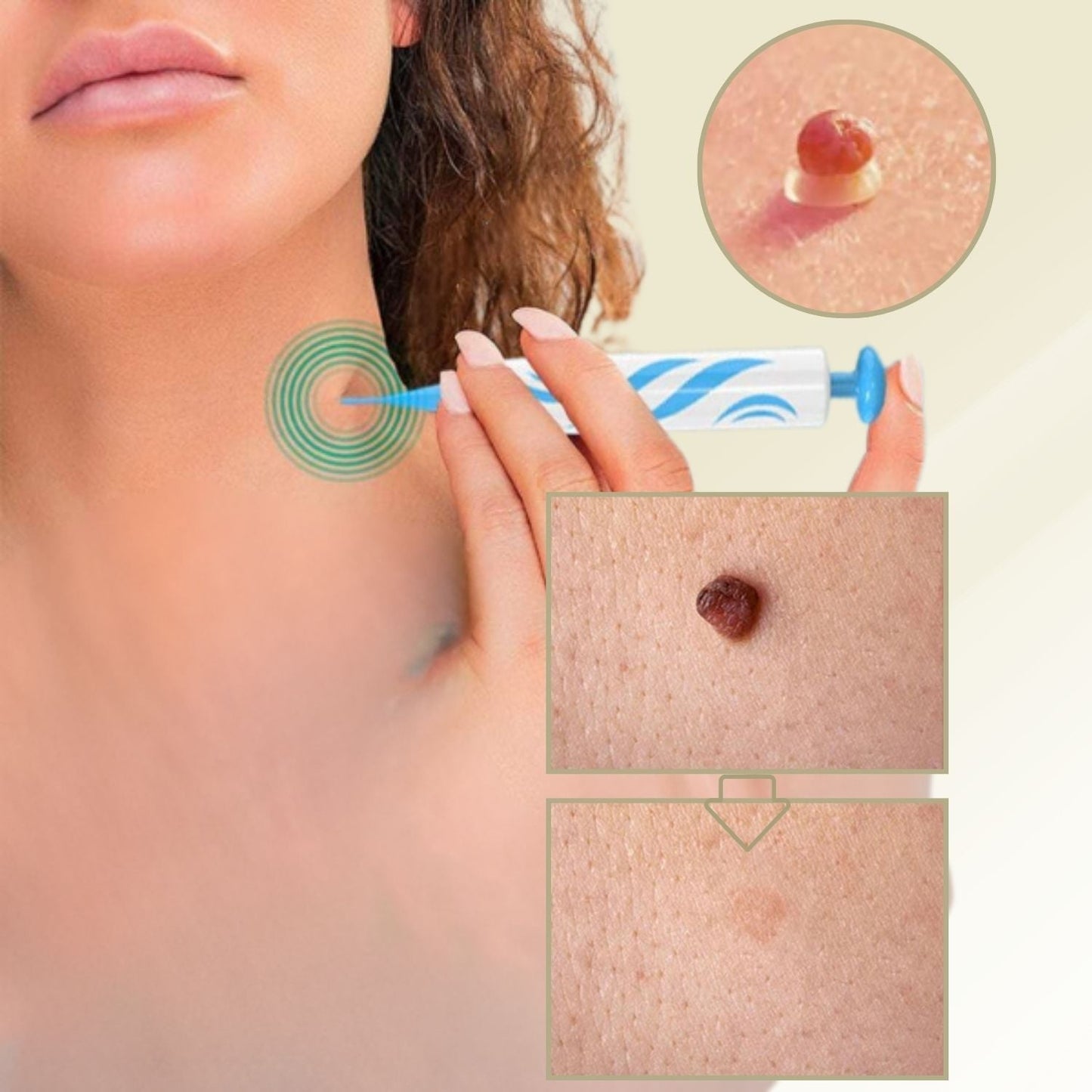 Easy Wart and Mole Remover for Home Use - Cofik