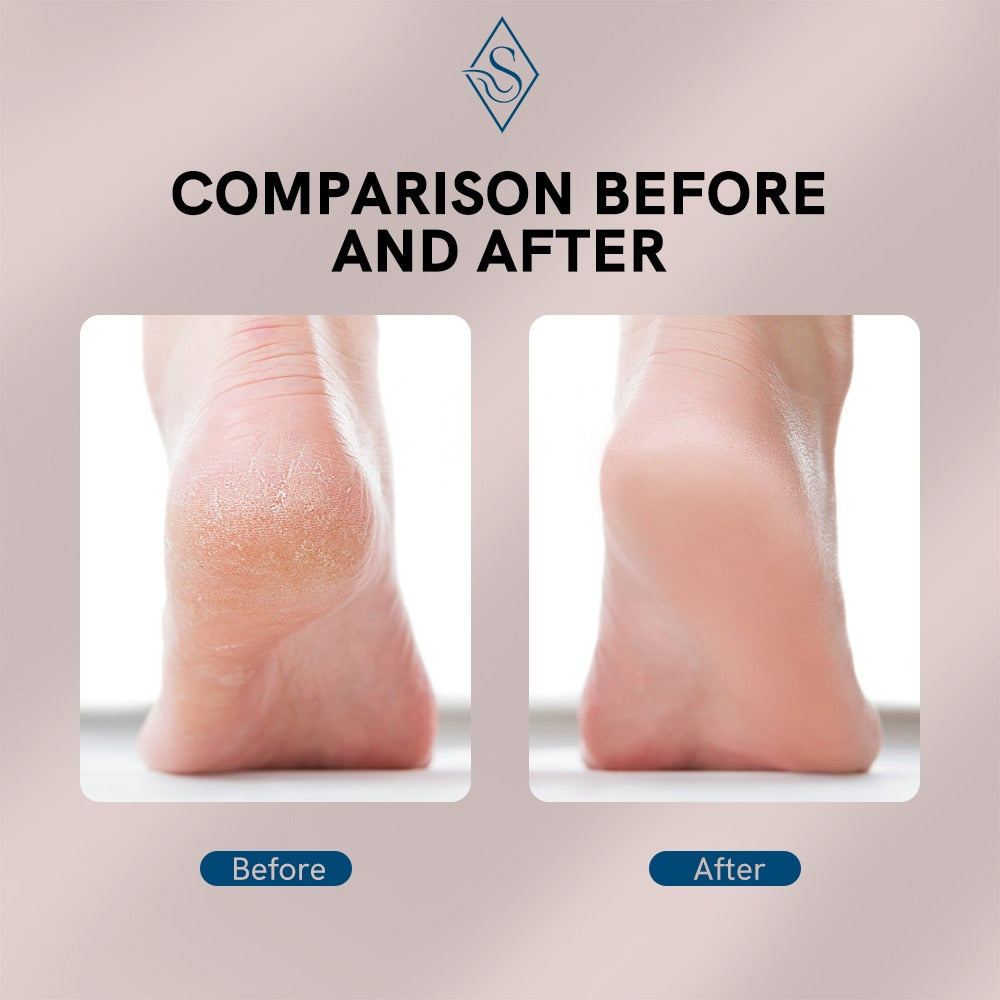 Fast Callus Remover For Feet