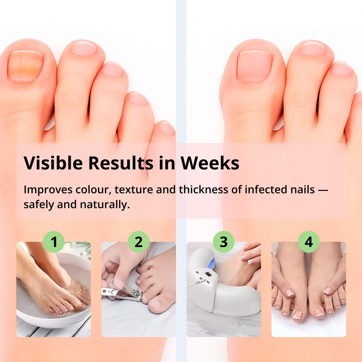 Professional At Home Nail Fungus Removal Laser Device
