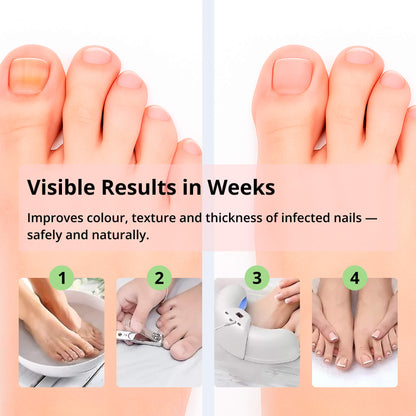 Professional At Home Nail Fungus Removal Laser Device