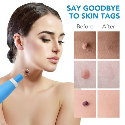 Effective Wart and Mole Remover Cream
