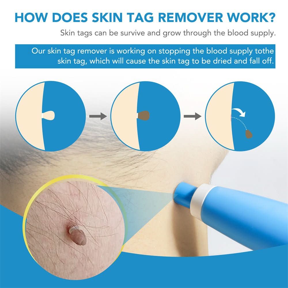 Effective Wart and Mole Remover Cream