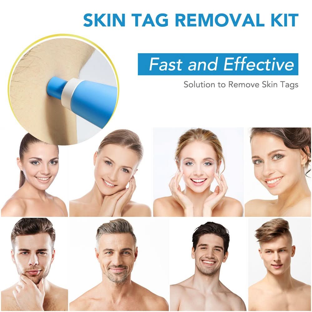 Effective Wart and Mole Remover Cream