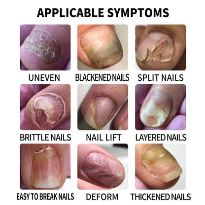 Natural Nail Fungus Treatment Serum