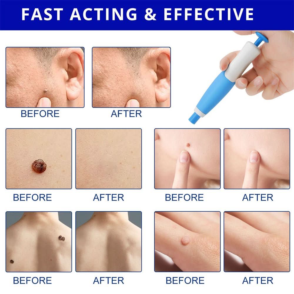 Effective Wart and Mole Remover Cream