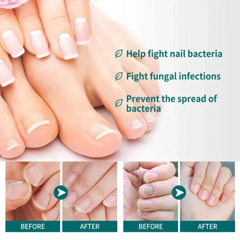 Natural Nail Fungus Treatment Serum