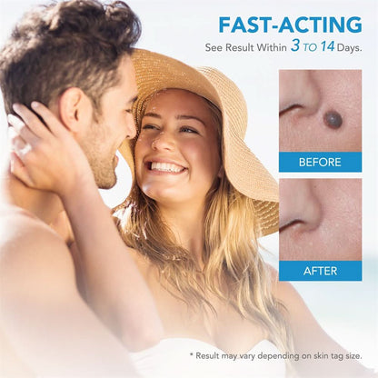 Effective Wart and Mole Remover Cream