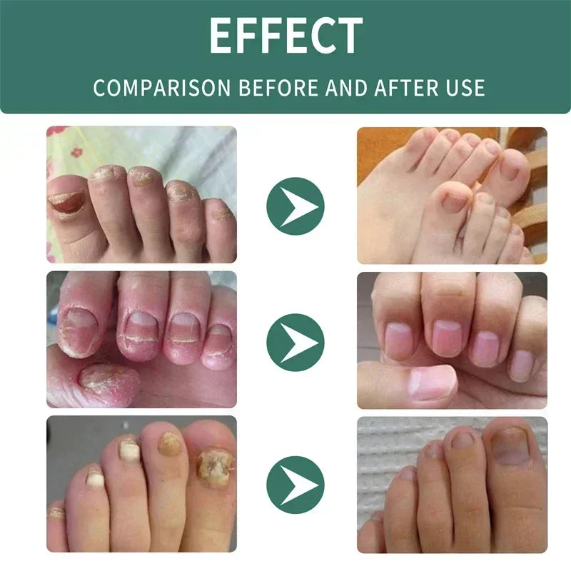 Natural Nail Fungus Treatment Serum