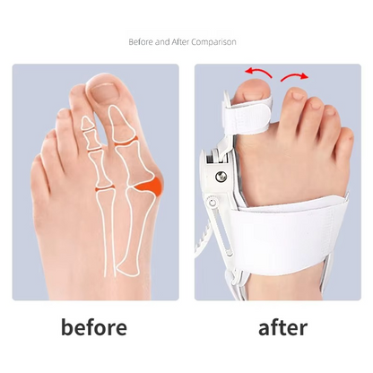 Bunion Relief Toe Spacer Orthotic Foot Support