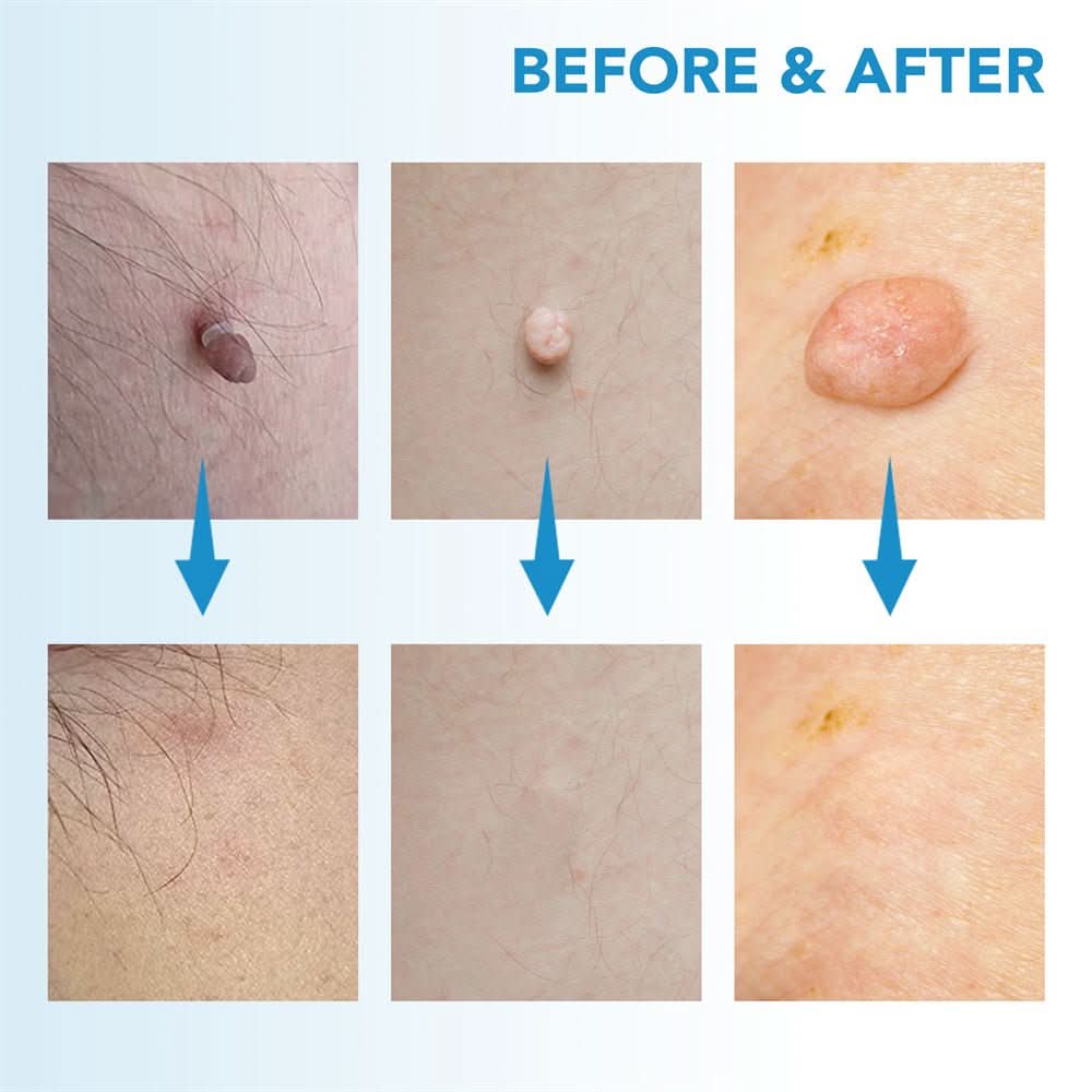 Effective Wart and Mole Remover Cream