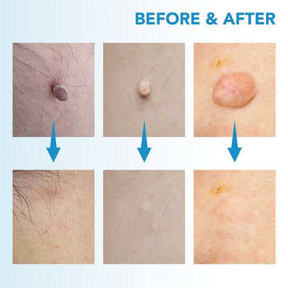 Effective Wart and Mole Remover Cream