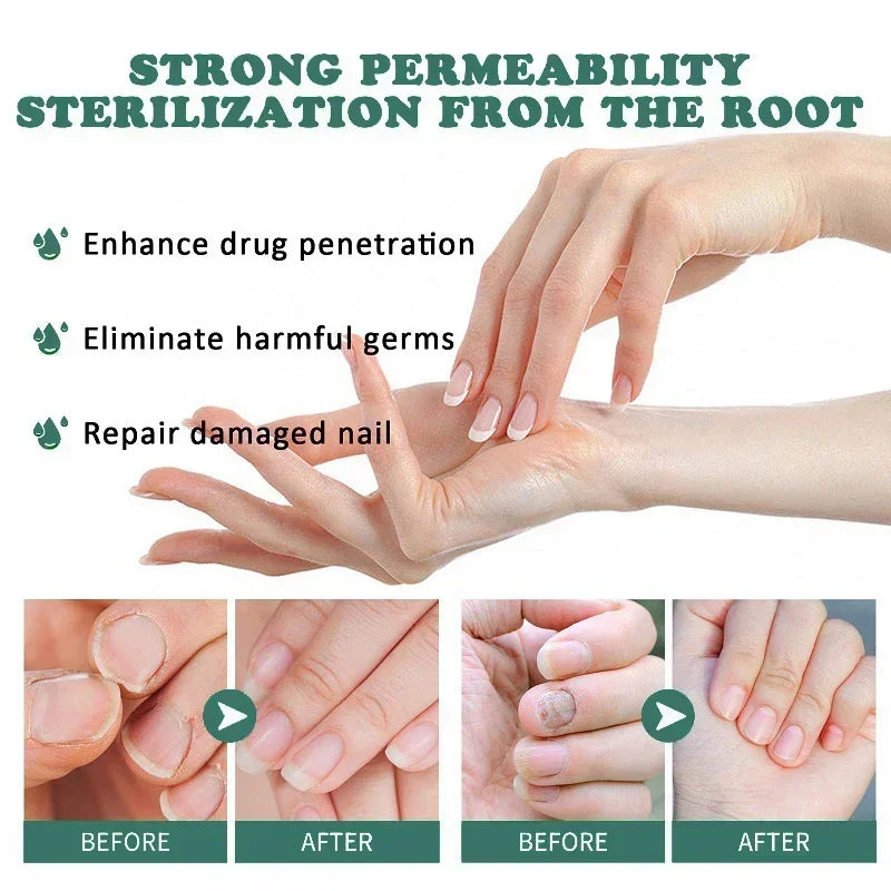 Natural Nail Fungus Treatment Serum