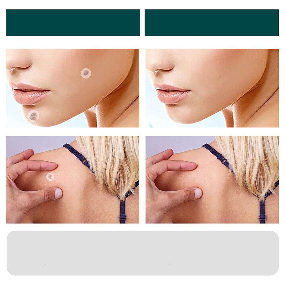 Fast Spot and Wart Removal Plaster