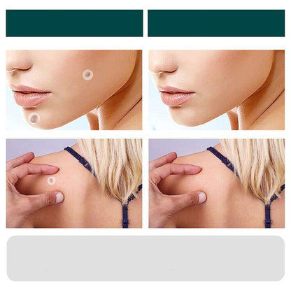 Fast Spot and Wart Removal Plaster