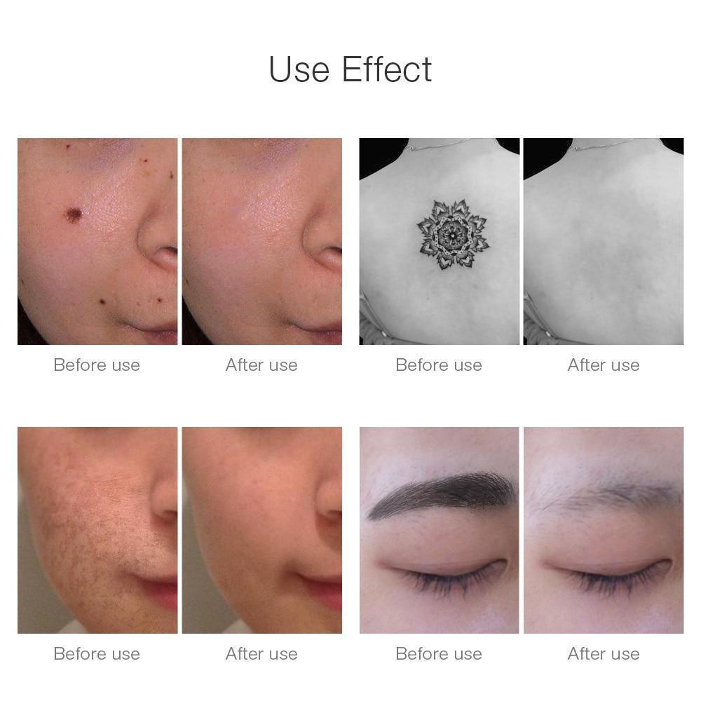 Fast Laser Skin Spot Tattoo Removal Device
