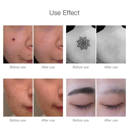 Fast Laser Skin Spot Tattoo Removal Device