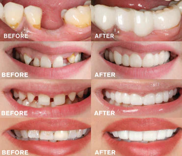 Easy Fit Dental Implant Snap On Denture