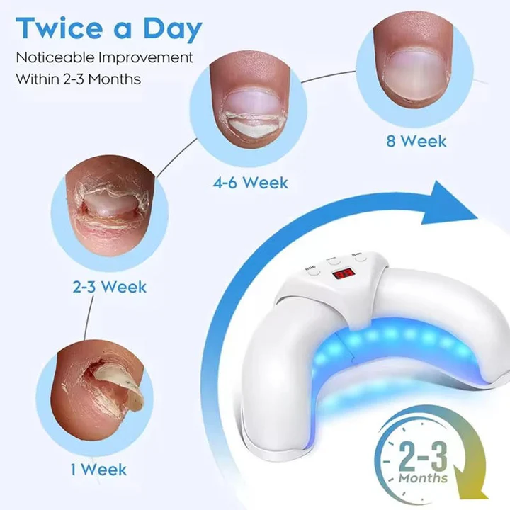 Effective Toenail Fungus Removal Laser