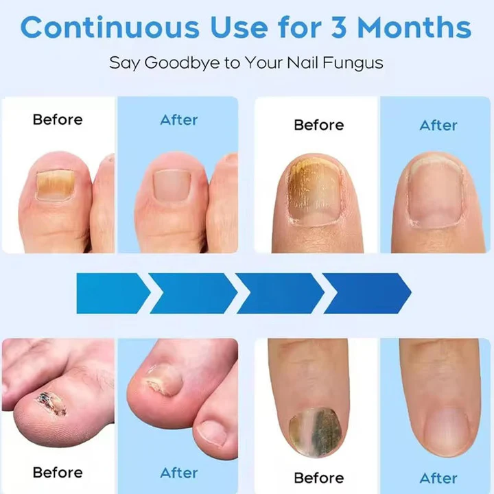 Effective Toenail Fungus Removal Laser