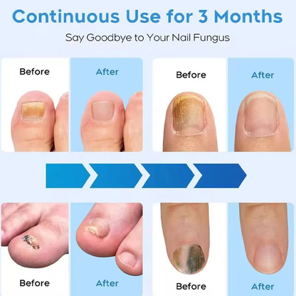 Effective Toenail Fungus Removal Laser