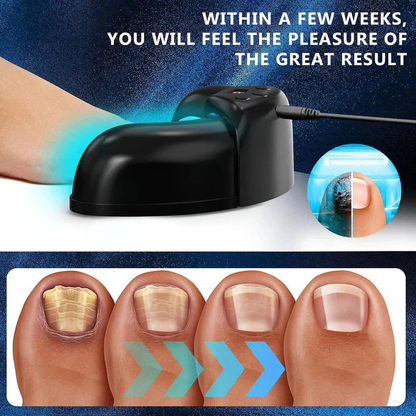 Effective Toenail Fungus Removal Laser