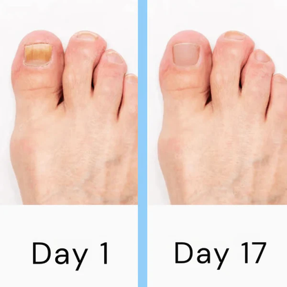 Advanced At Home Nail Fungus Treatment Device