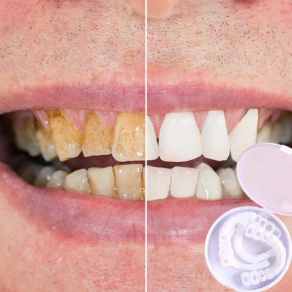 Easy Fit Smile Veneers