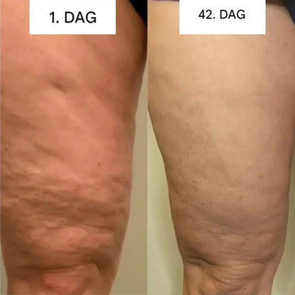 GlowCup – Cellulite Remover and Skin Tightening with Red Light and Cupping Therapy
