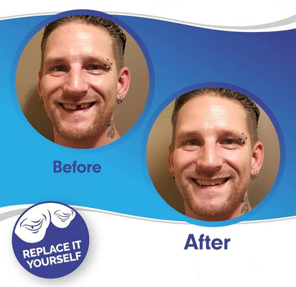 Reusable Snap On Dental Veneers for Upper Lower Teeth