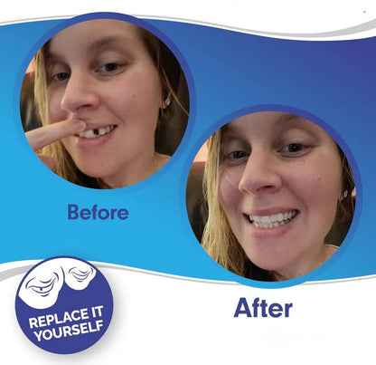 Reusable Snap On Dental Veneers for Upper Lower Teeth