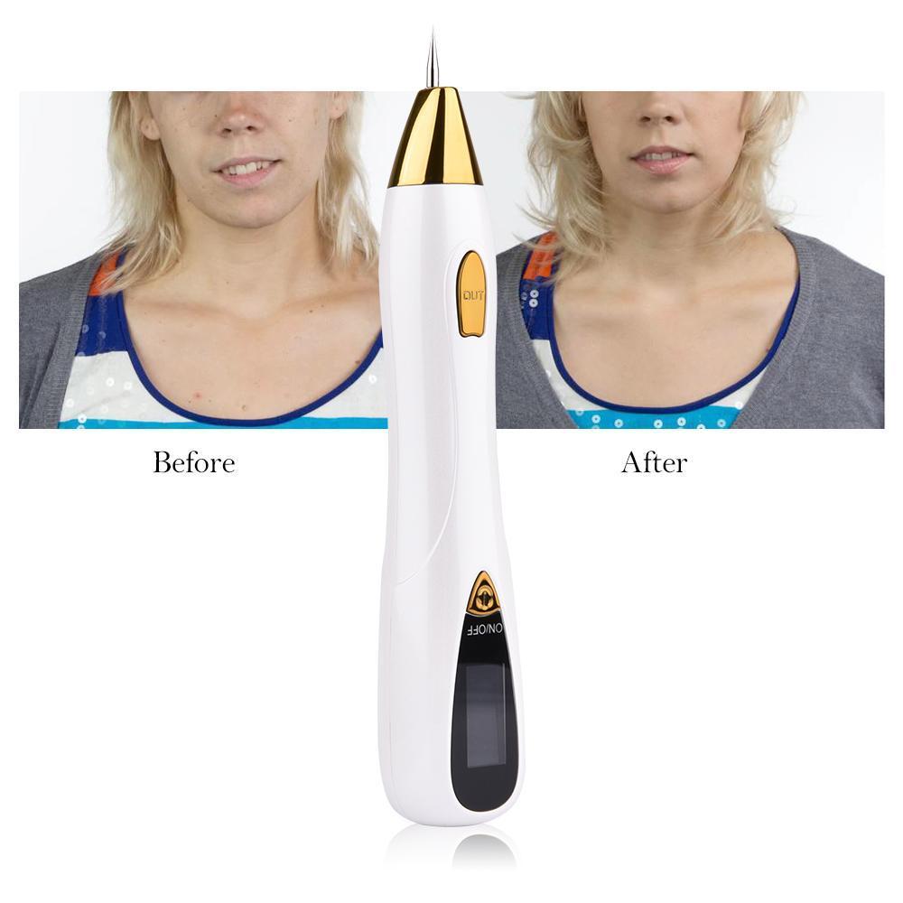 Effective Skin Tag and Mole Removal Tool